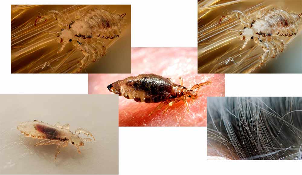 lice-on-head